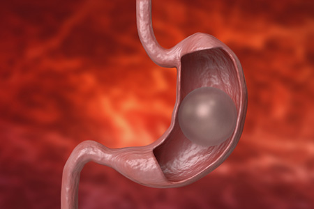 balao_gastrico_mobile2